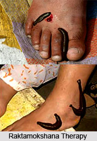 Raktamokshana, Ayurveda
