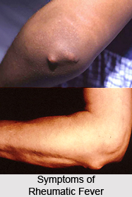 Rheumatic Fever or Aamavata Jwara