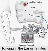 Ringing in the Ear or Tinnitus