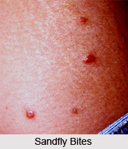 Sandfly Fever or Marumakshika Jwara