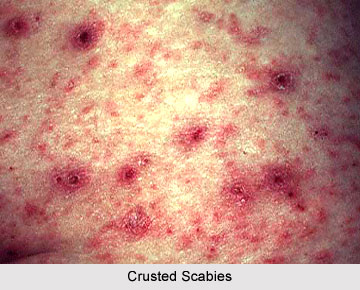 Scabies, Skin Disorders