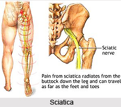 Sciatica or Gridhrasi