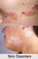 Skin Disorders, Naturopathy