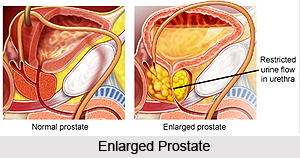 Symptoms in Prostate Disorders