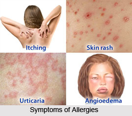 Symptoms of Allergies