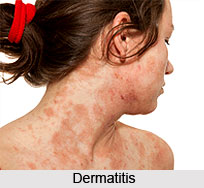 Symptoms of Dermatitis