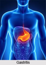 Symptoms of Gastritis