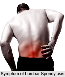 Symptoms of Lumbar Spondylosis