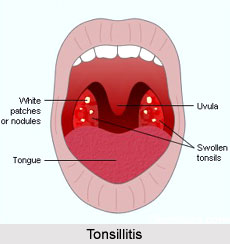 Home Remedies for Tonsillitis