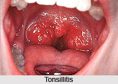 Tonsillitis