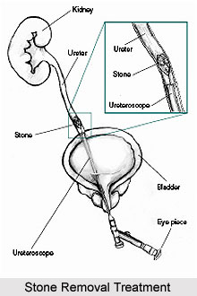 Treatment of Kidney Disorders