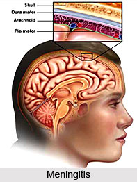 Treatments of Meningitis