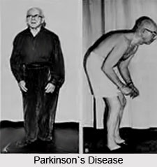 Treatments of Parkinson`s disease