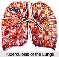 Tuberculosis of the Lungs
