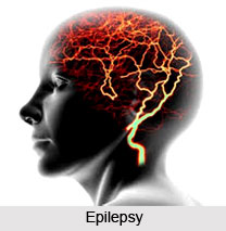 Types of Epilepsy