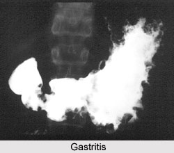Gastritis