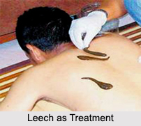 Use of Leech as Treatment