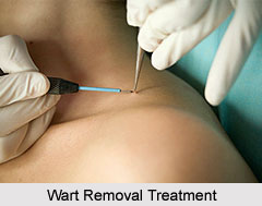 Treatments of Warts