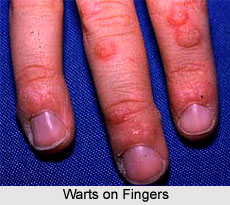 Warts on Fingers