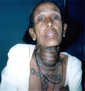 Goitre or Galaganda
