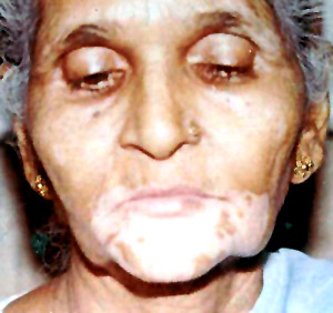 Leucoderma or Kilas